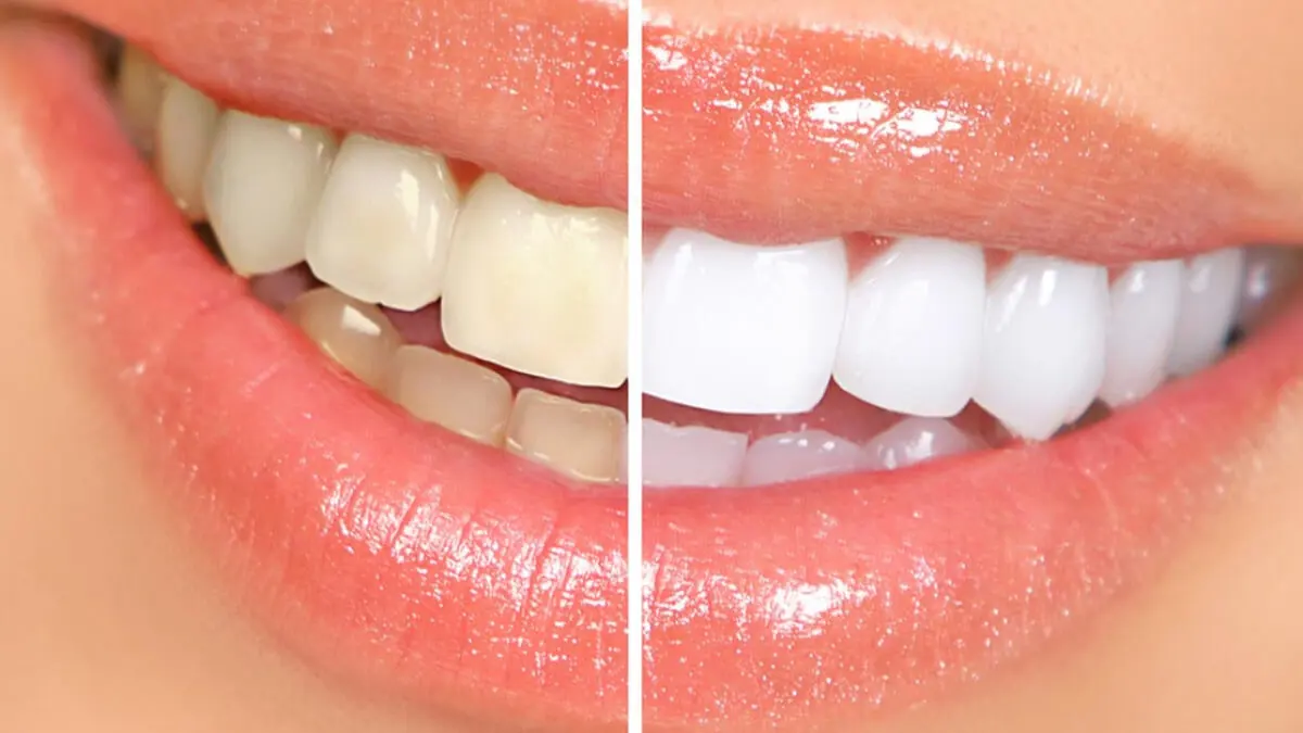 Blanqueamiento de dientes