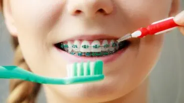 Cómo cepillarse correctamente los dientes con «brackets»