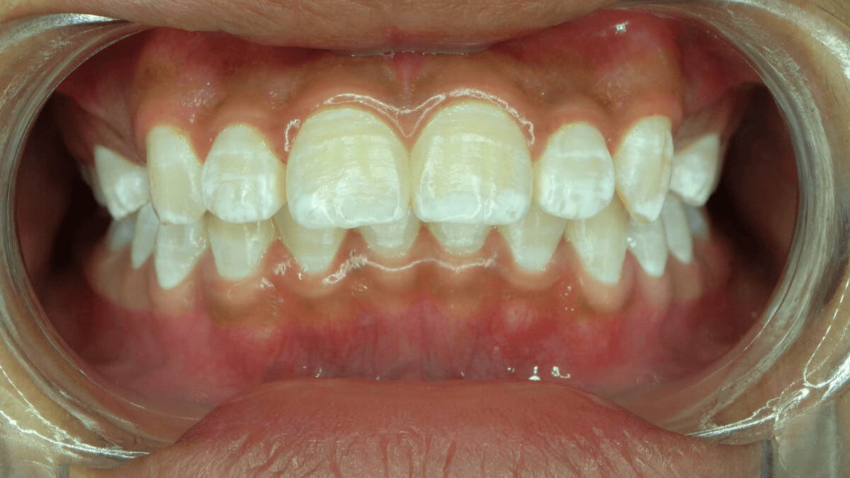 Manchas blancas en los dientes