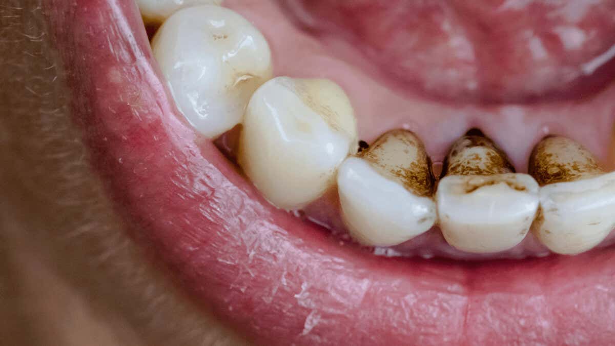 Manchas marrones en los dientes, cerca de las encías