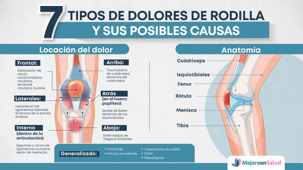 Locaciones de los distintos tipos de dolores de rodilla.
