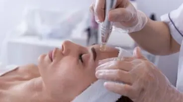 ¿Cuáles son los beneficios del «microneedling»?