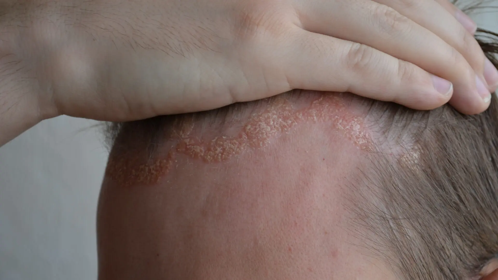 Dermatitis seborreica por VIH.