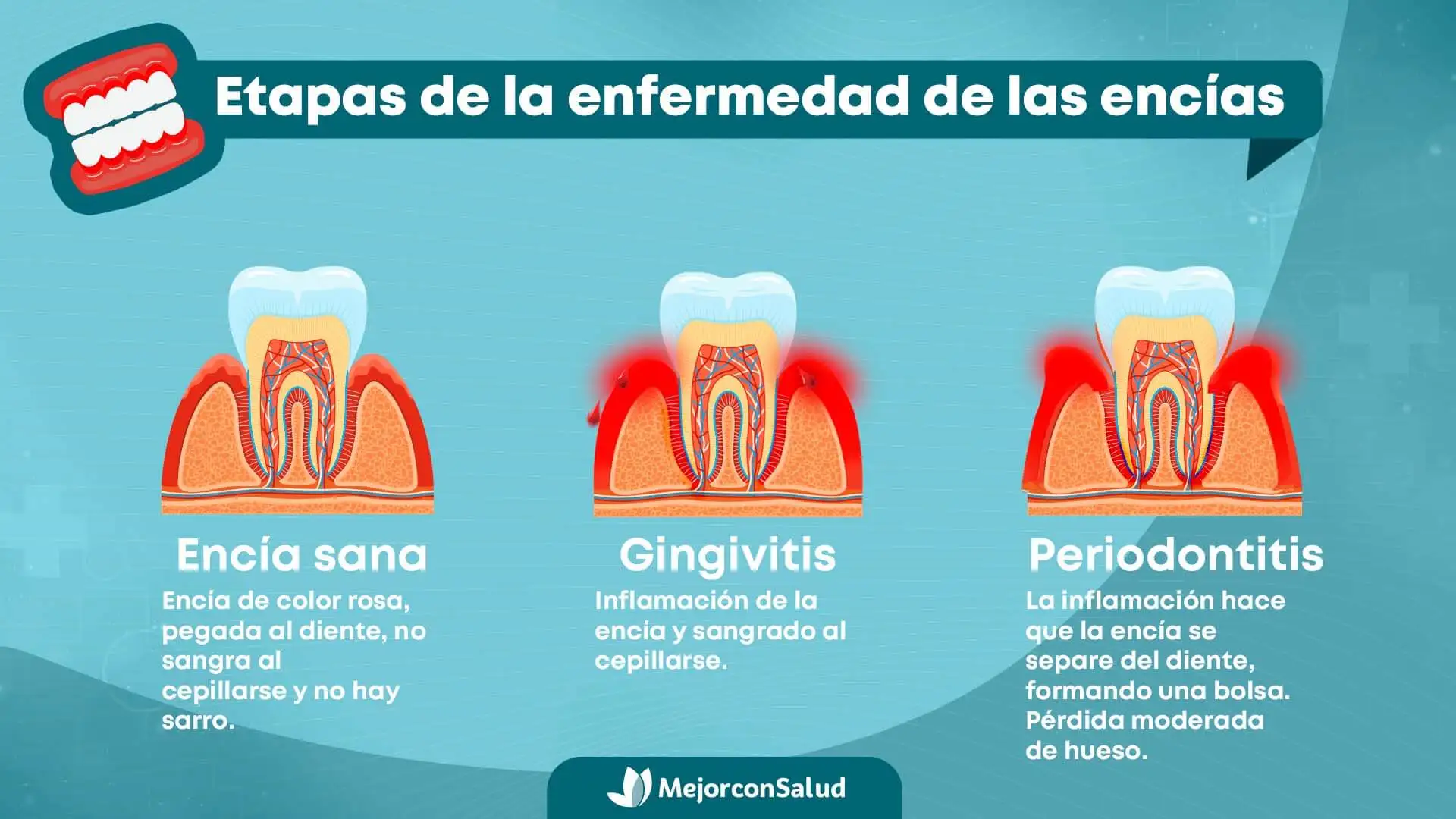 Etapas de la enfermedad de las encías con gingivitis y periodontitis.
