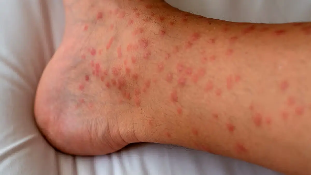 Erupción papular pruriginosa.