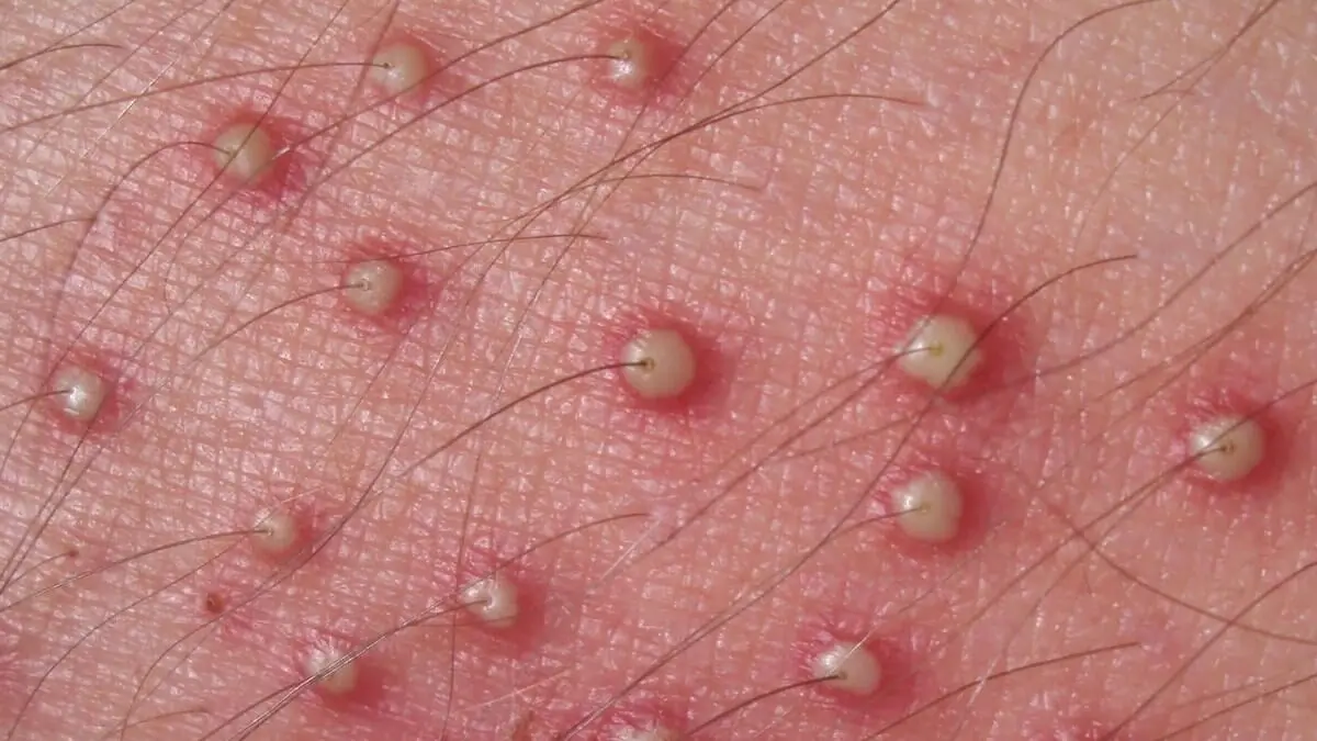 Foliculitis eosinofílica por VIH.