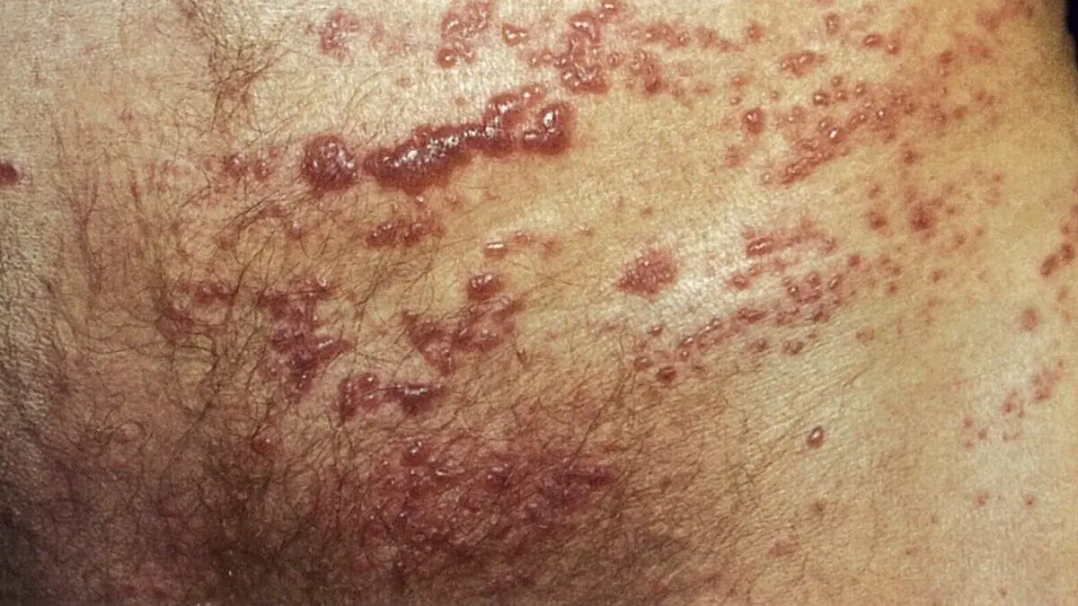 Sarpullido por VIH en los genitales.
