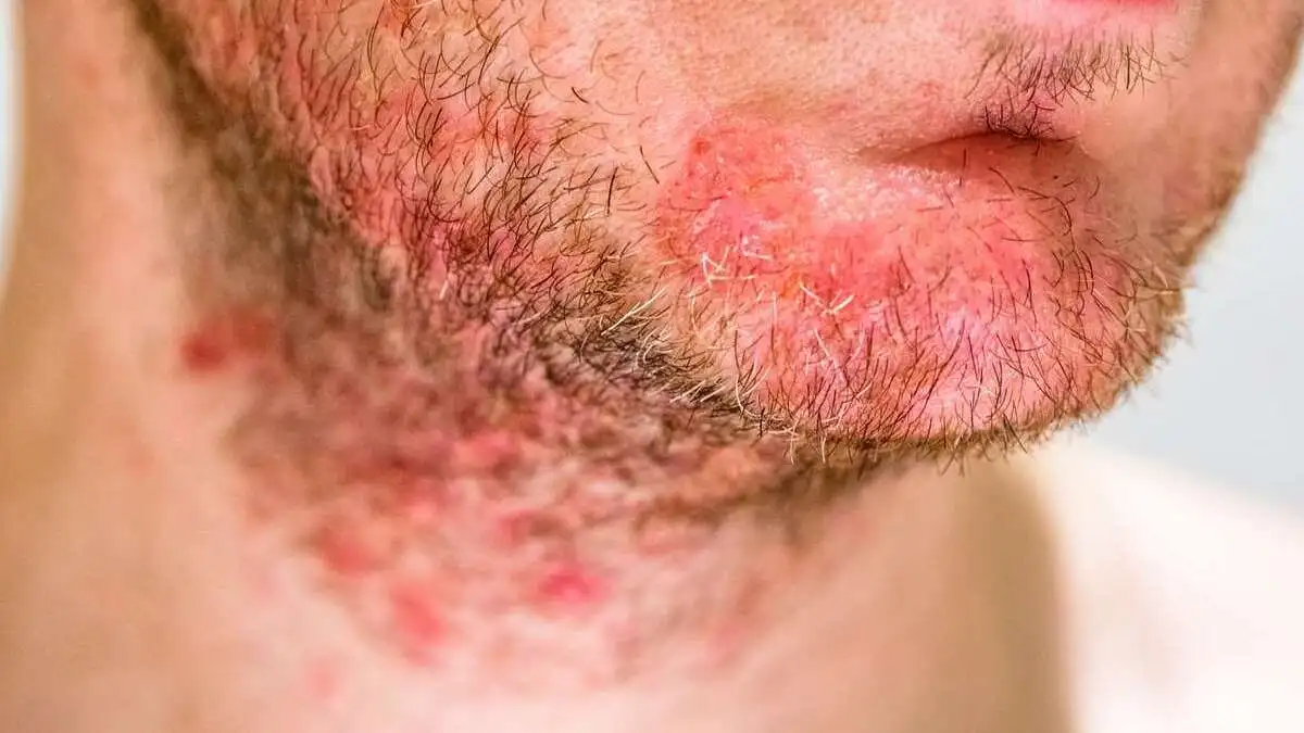 Sarpullido en el rostro por VIH.