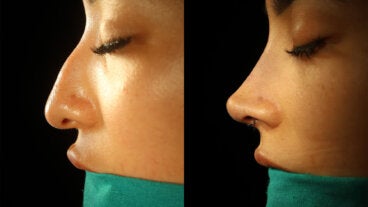 Medicamentos y suplementos para antes y después de una rinoplastia