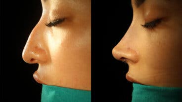 Medicamentos y suplementos para antes y después de una rinoplastia