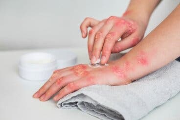 Psoriasis nerviosa: qué es, causas y cómo identificarla