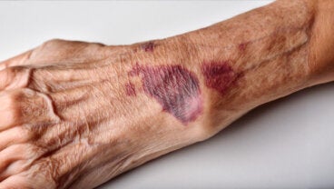 ¿Por qué salen moretones en la piel sin haberse golpeado?