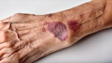 ¿Por qué salen moretones en la piel sin haberse golpeado?