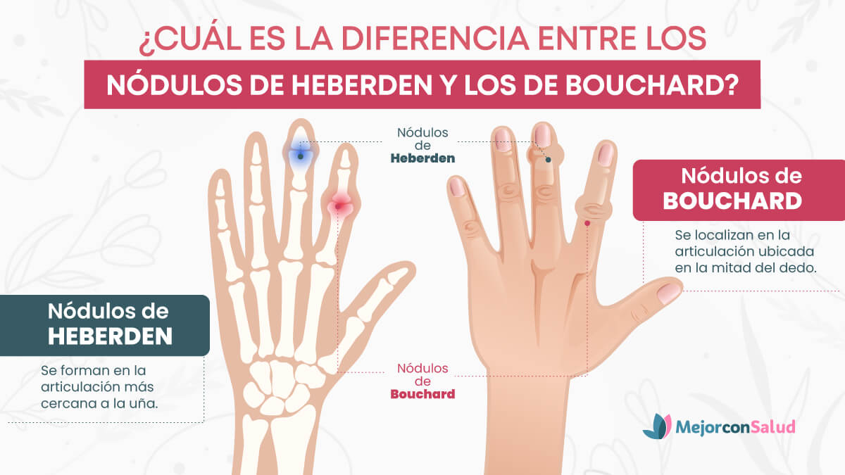 ¿Cuál es la diferencia entre los nódulos de Heberden y los de Bouchard?