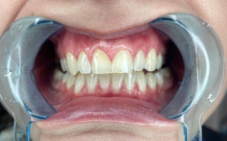 Los hábitos que dañan tus encías, según el odontólogo Jesús Palma Ortiz