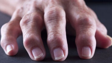 Qué son los nódulos de Bouchard y por qué aparecen